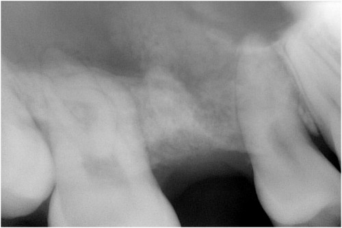 田村2　抜歯後約4ヶ月